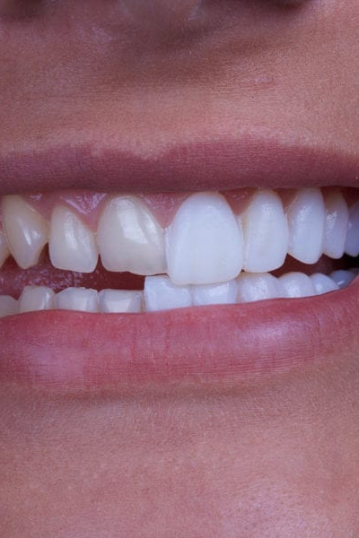 Professional Teeth Whitening in Lake Worth