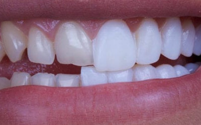 Professional Teeth Whitening in Lake Worth